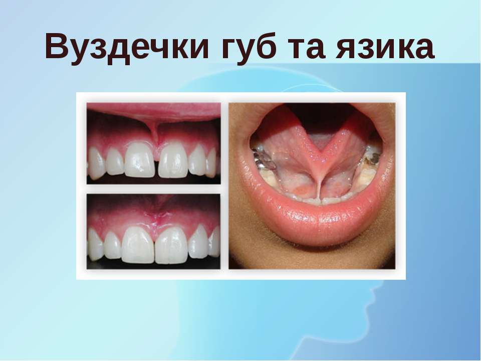 Вуздечки губ та язика - Скачать презентации бесплатно | Читать или скачать учебники для школы онлайн бесплатно ☑ Школьные учебники school-textbook.com