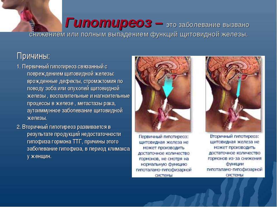 Гипотиреоз - Скачать презентации бесплатно | Читать или скачать учебники для школы онлайн бесплатно ☑ Школьные учебники school-textbook.com