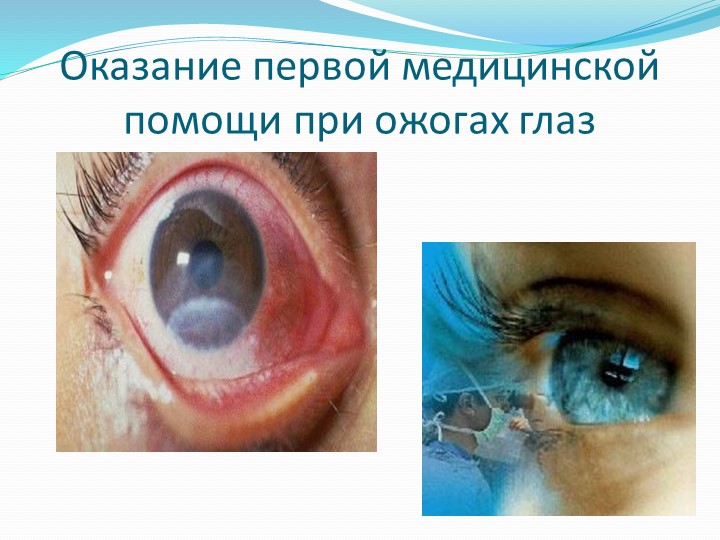 Презентация на тему: "Оказание первой медицинской помощи при ожогах глаз" - Скачать презентации бесплатно | Читать или скачать учебники для школы онлайн бесплатно ☑ Школьные учебники school-textbook.com